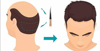 Пересадка волос FUE-методом от 1400 до 2100 графтов