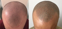 Медицинская скальпопигментация волосистой части головы