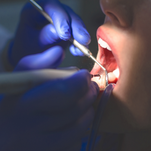 Эстетико-функциональное восстановление зуба